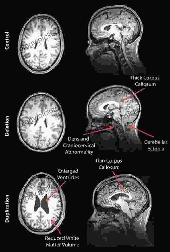 A Brain Scan Of A Person With An Unusually Large Hippocampus, Highlighting The Importance Of This Region For Memory And Navigation. The Disordered Mind: What Unusual Brains Tell Us About Ourselves